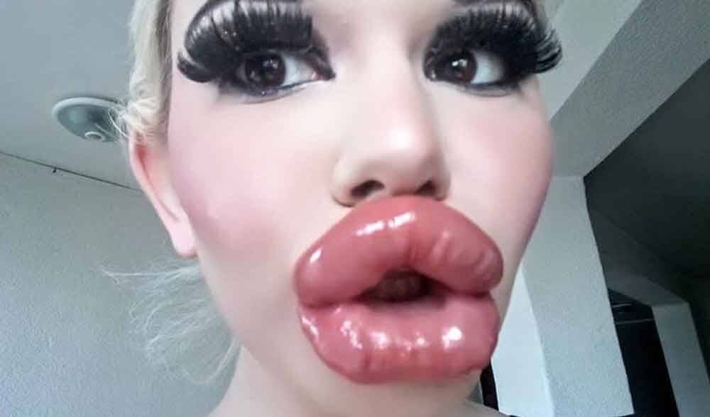 'Barbie da vida real', quer os maiores lábios do mundo