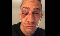 Astro do UFC posta foto de como ficou após derrota para Vicente Luque