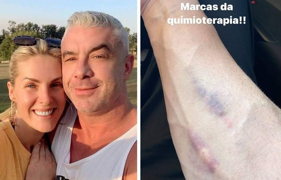 Alexandre Correa, marido de Ana Hickmann, mostra hematomas do tratamento contra o câncer