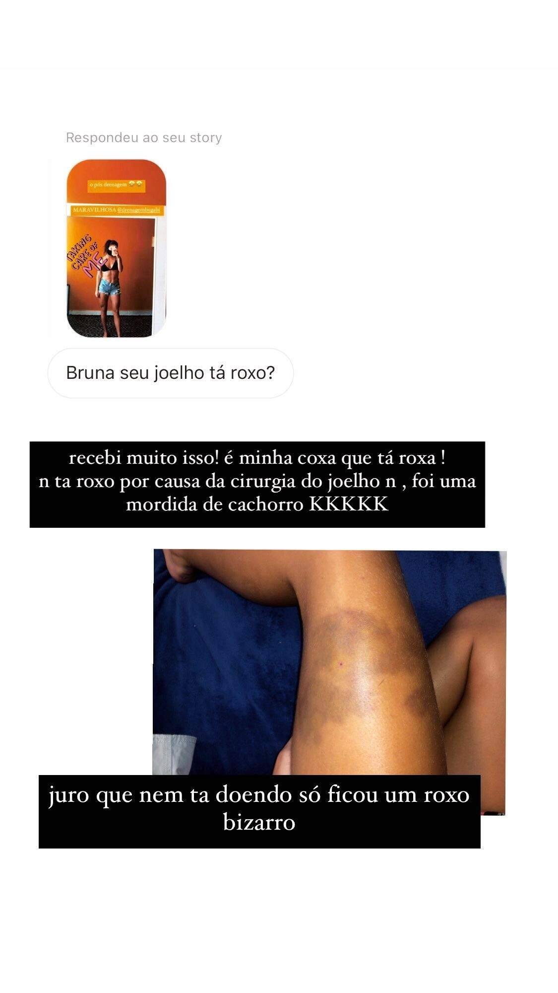 Bruna Griphao mostra roxo na perna após ter sido mordida por um cachorro. (Foto: Reprodução/Instagram)