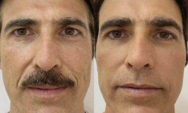 Reynaldo Gianecchini faz rejuvenescimento facial e impressiona com antes e depois