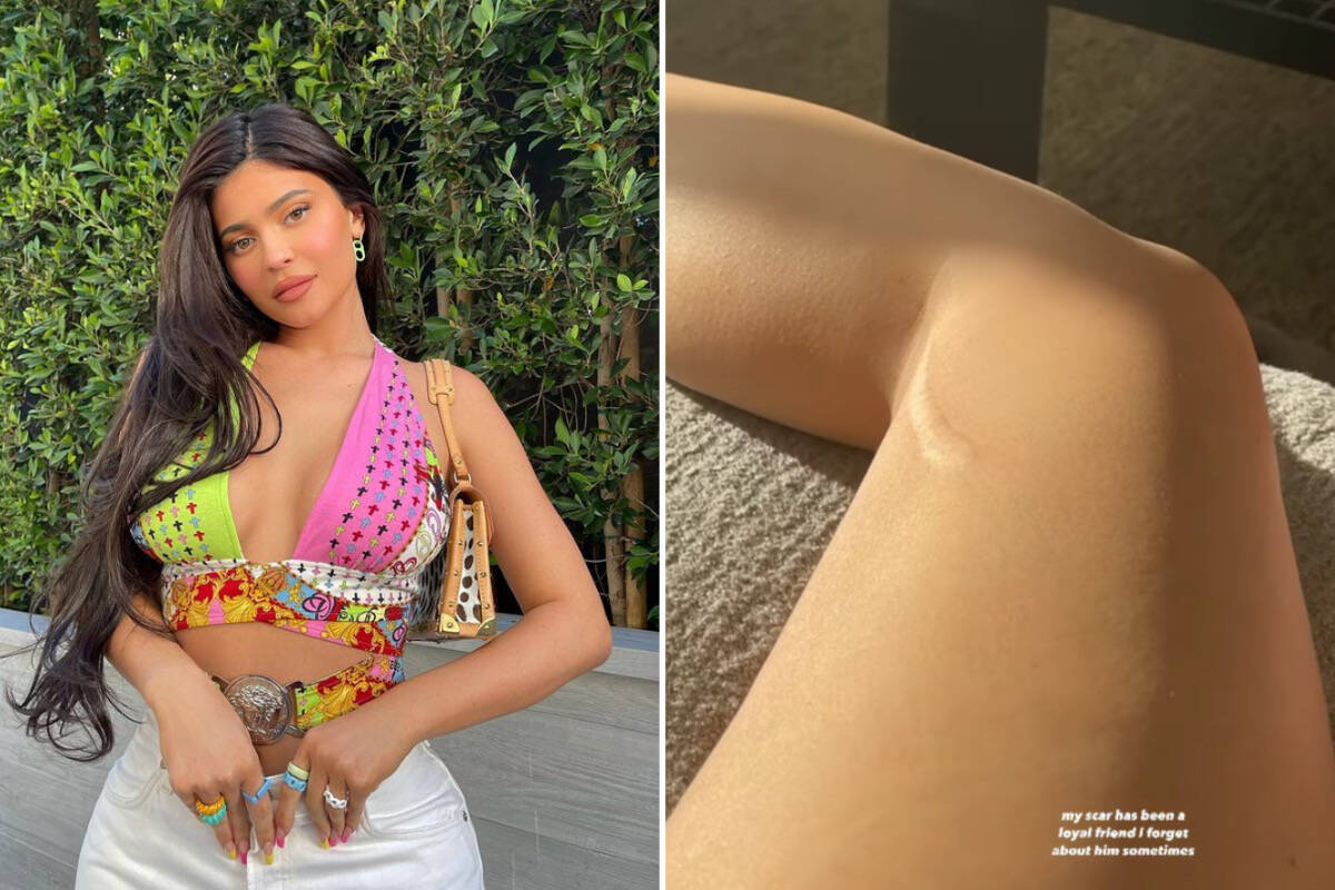Kylie Jenner posta foto da cicatriz e reflete: "Amiga fiel"