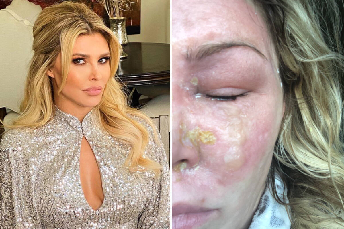Ex-modelo teve queimaduras de segundo grau no rosto após tratamento para psoríase: "Só quero chorar"