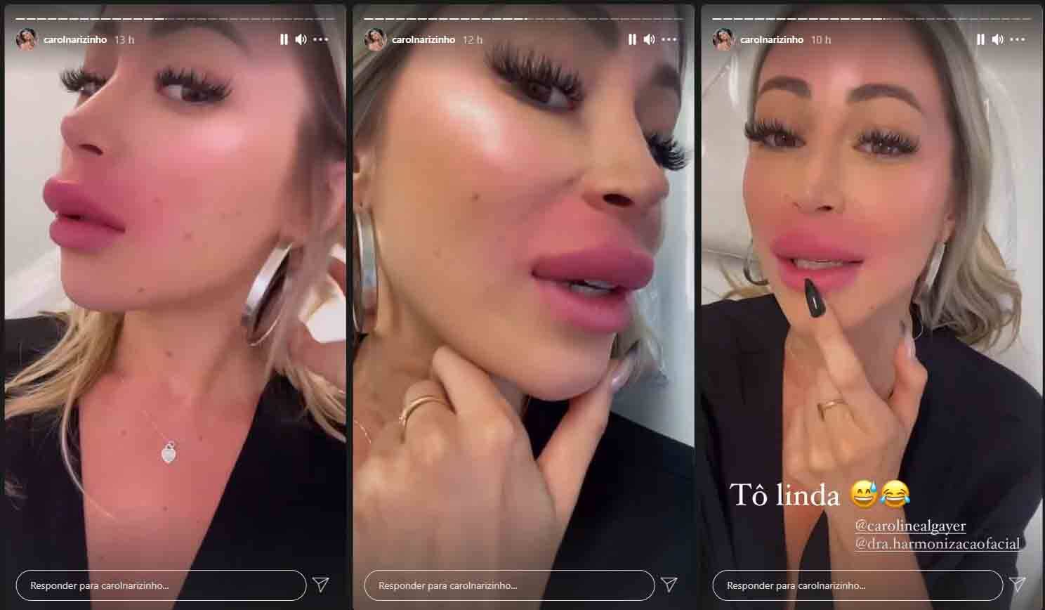 Carol Narizinho fica com os lábios com o dobro do tamanho após preenchimento labial . Foto: reprodução Instagram