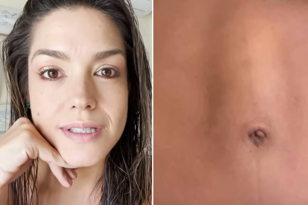 Thais Fersoza revela que fez uma cirurgia para corrigir diástase abdominal