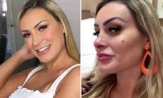 Andressa Urach faz harmonização facial: "Cara de rica"