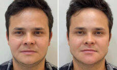 Antes e depois: Matheus, da dupla com Kauan, faz harmonização facial