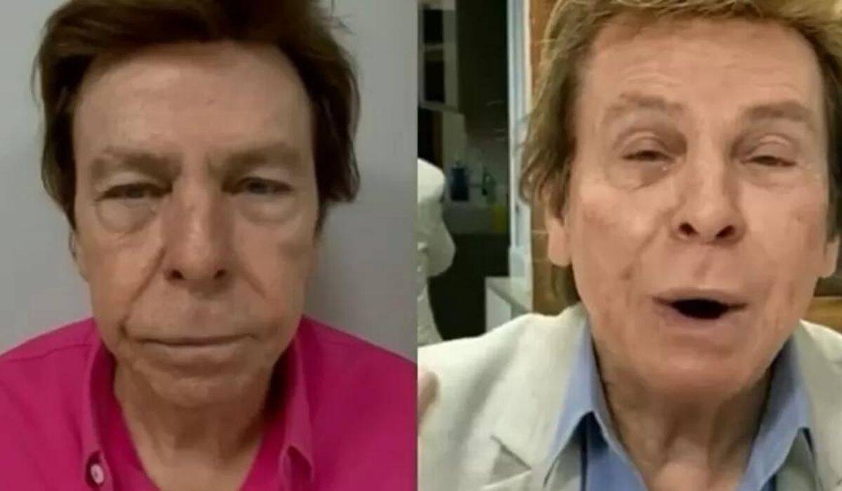 Nelson Rubens exibe antes e depois do rosto após a harmonização facial