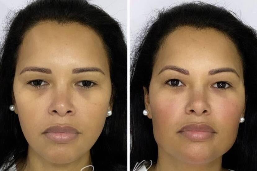 Ariadna Arantes faz harmonização facial; veja antes e depois