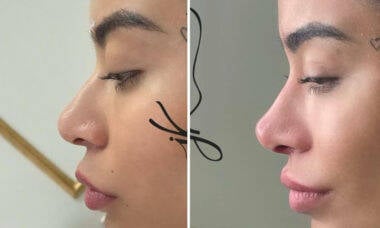 Rafaella Santos faz rinomodelação e retoca harmonização facial